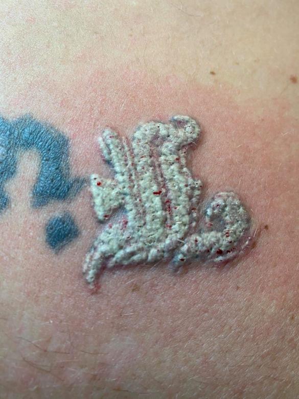 Na czym polega laserowe usuwanie tatuaży: